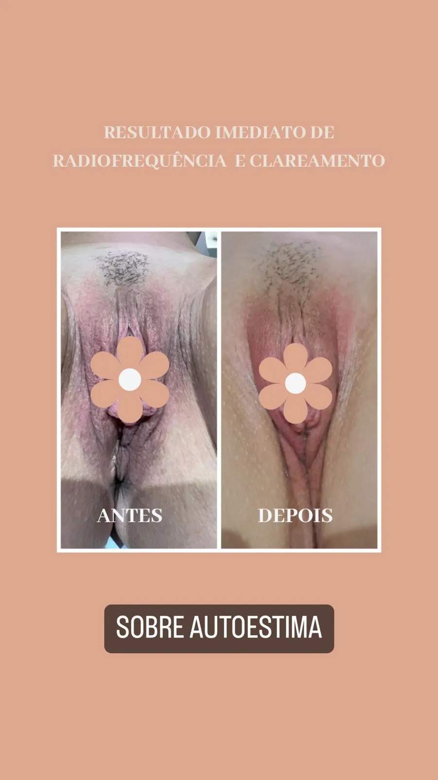 Registro de antes e depois de procedimento de estética íntima